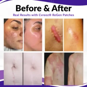 Cvreoz® ReGen Microneedles Pro Patches
