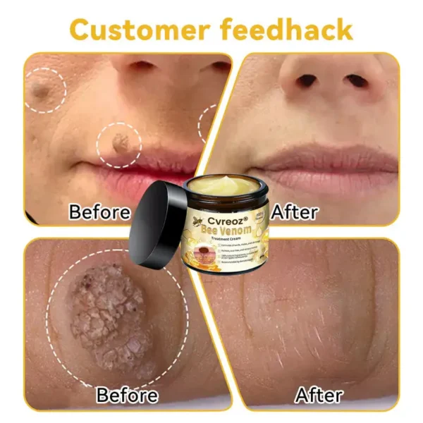 🔥FDA Approved⭐ WHO Approved🌍 Cvreoz® Bee Venom Skin Treatment Cream - Fast and effective⚡ targeting all skin issues✅ If ineffective, a refund is guaranteed💯