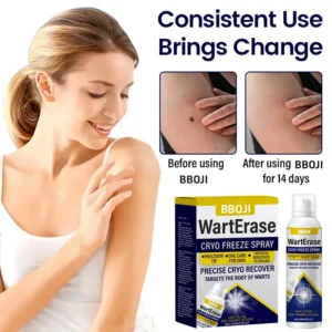 BBOJI WartErase Cryo Freeze Spray