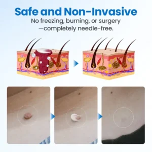 Timilk® TagGone Wart Removal Cream 🔥