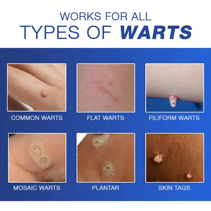 🔥Warts No More - 50% OFF | Cvreoz® Wart Eraser Pro (Copy)
