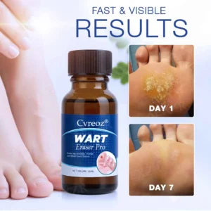 🏷️ EXCLUSIVE DEAL! 32% OFF - Cvreoz® Wart Eraser Pro